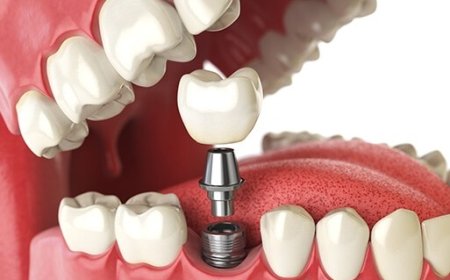 Dental Implants in Dubai vs. Dentures: Which Is the Better Option?