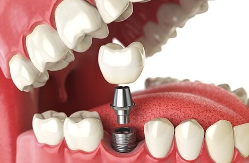 Dental Implants in Dubai vs. Dentures: Which Is the Better Option?