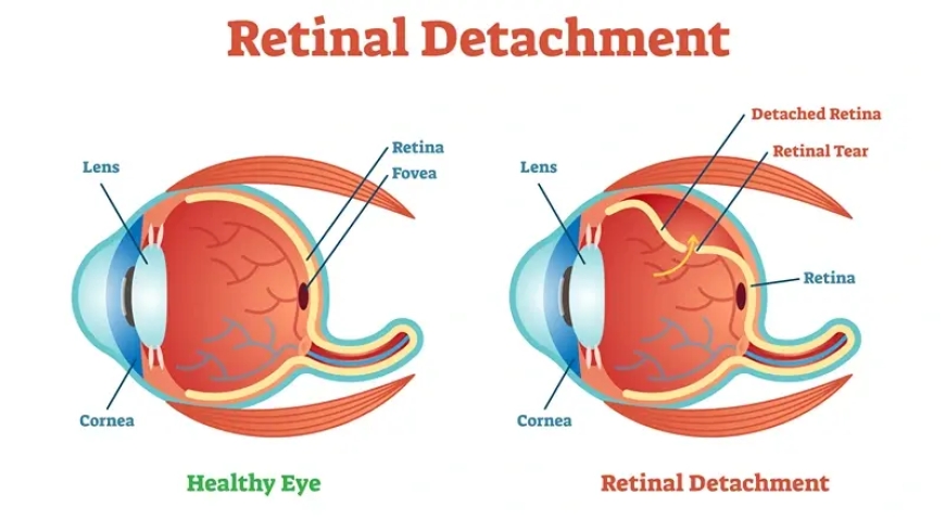 Eye Health After Retinal Detachment Surgery – Tips and Guidance from Dr. Mandeep Lamba, Dubai