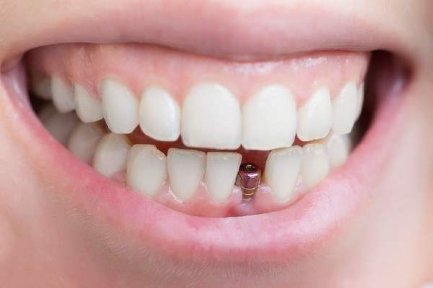 Why Dental Implants Are the Best Option for Missing Teeth